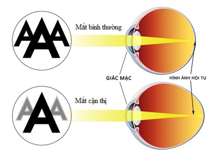 cac-phuong-phap-dieu-tri-can-thi