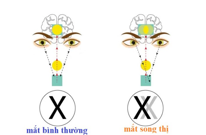 bi-song-thi-nhin-doi-la-dau-hieu-cua-benh-gi-dieu-tri-the-nao