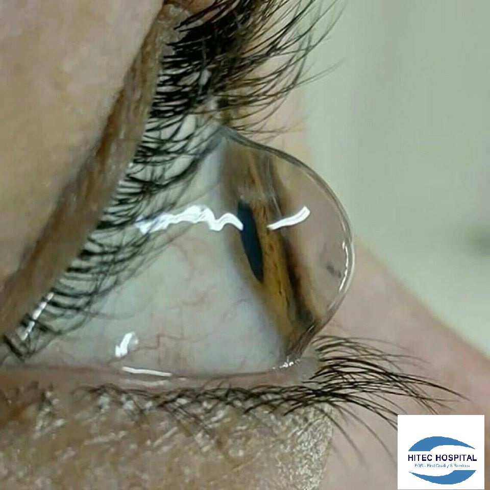 benh-giac-mac-chop-keratoconus