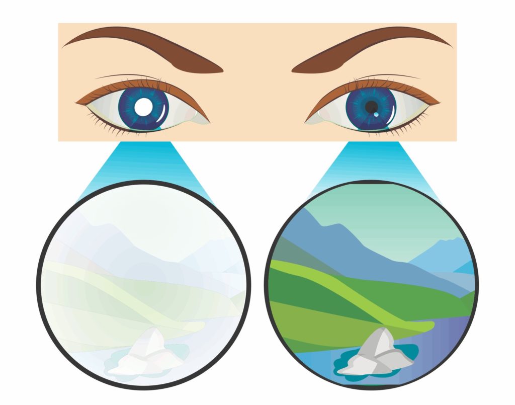 benh-nhuoc-thi-o-nguoi-lon-co-nguy-hiem-khong-chua-nhu-the-nao