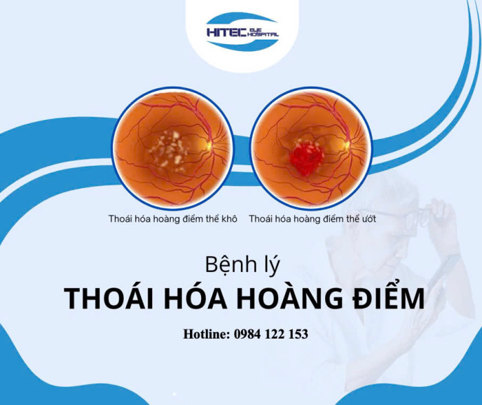 thoai-hoa-hoang-diem-hieu-dung-ve-benh-ly-gay-suy-giam-thi-luc-hang-dau-o-nguoi-cao-tuoi