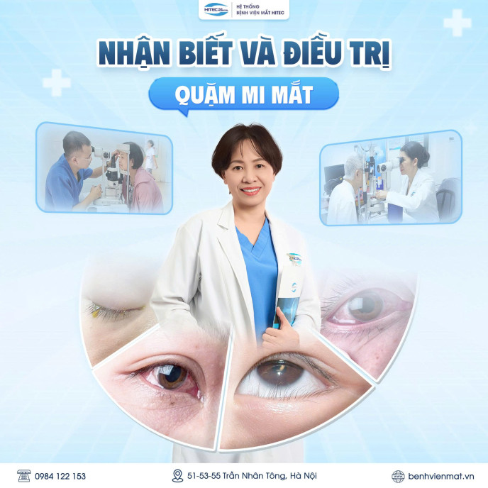 quam-mi-mat:-nguyen-nhan-trieu-chung-va-cach-dieu-tri-dut-diem