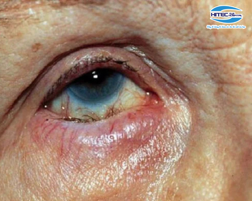 15-dau-hieu-lao-hoa-mat-pho-bien-amp;-cach-bao-ve-thi-luc-hieu-qua