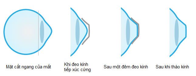 Kính Ortho-K có công dụng kiểm soát tiến triển cận thị và triệt tiêu độ khúc xạ tạm thời