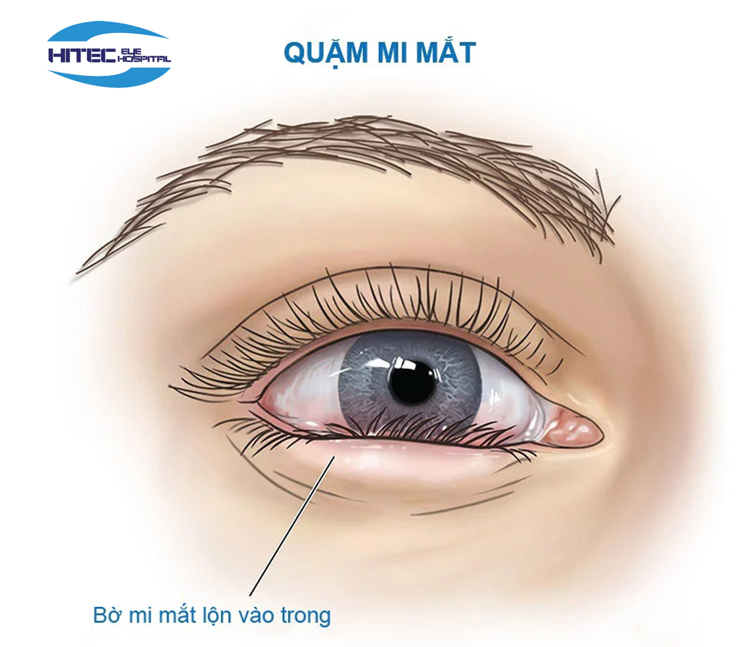 Bệnh quặm mi mắt